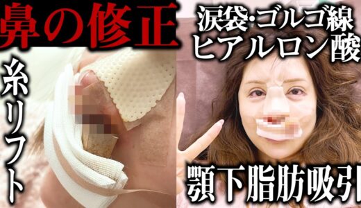 【整形手術】覚悟がある人だけ見てください。【鼻修正／顎下脂肪吸引／糸リフト／ヒアルロン酸】