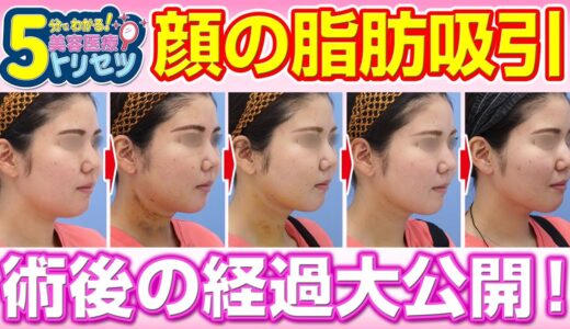 【美容医療のトリセツ】 小顔のための脂肪吸引！ダウンタイムはどんな感じ？【湘南美容クリニック医師が5分で解説】