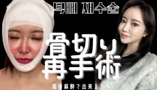 【美容整形】顎の骨切り手術のダウンタイム全貌！/ 미니브이라인 턱수술 전후