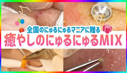 【角栓除去/まぶたの脂肪取り】シリーズ累計700万回再生超！にゅるにゅるマニアへ贈る至福の5分間【ブラックヘッド】Blackhead Removal Show / Eyelid fat removal