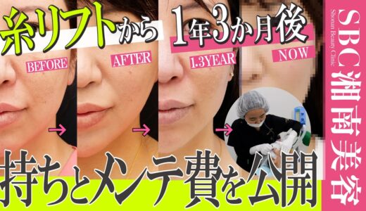 【アラフォーたるみ整形密着】糸リフト1年3か月後でどこまでキープできた？メンテ費は？リアルな経年変化をお見せします【ほうれい線とたるみ治療の現実】湘南美容クリニック