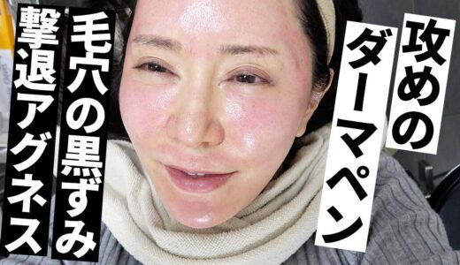 【肌治療に本気だす】白ニキビが治るらしいとの美容治療を受けてみた。