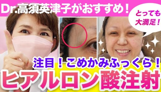 【50代女性】マスク生活におすすめ！ヒアルロン酸注射でこめかみふっくら！若々しく元気に見せます【アンチエイジング】