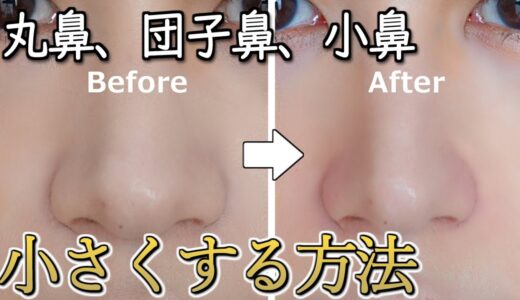 【整形した？】僕が鼻先の丸みと小鼻を解消した方法！