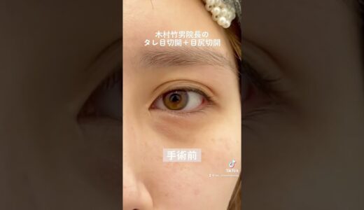 【美容整形】タレ目切開＋目尻切開【最近の可愛い子がやっている施術】#タレ目形成 #美容外科 #二重整形 #湘南美容クリニック #shorts