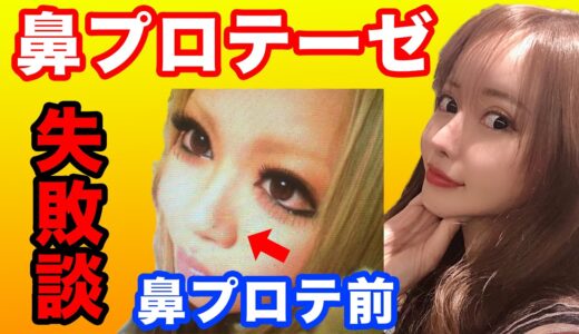 【美容整形】鼻プロテーゼ体験談＆失敗談！全部で5回プロテーゼを入れ直した内の1〜3回目のお話し【体験談】【整形】