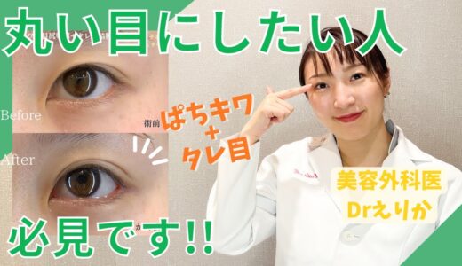 【美容整形】丸い目にするには？ぱちキワ（上瞼たるみ取り）&目尻切開&タレ目形成のリアル症例解説！