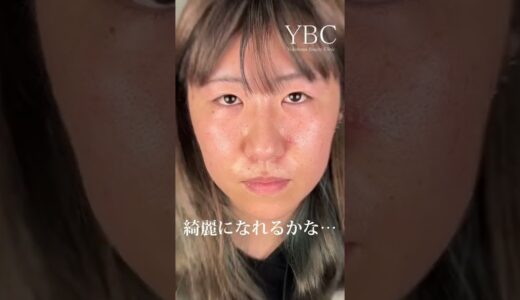 【美容整形】全顔フル整形完全密着待望の続編 二重全切開、目頭切開、目尻切開、鼻尖形成、YBC式鼻先シャープ術、YBC式鼻翼縮小、脂肪吸引、YBC式小顔リフト #shorts