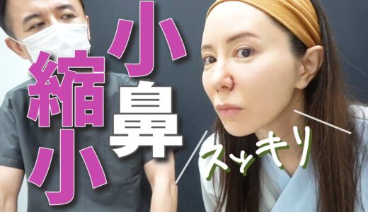 【小鼻縮小】まだ私の鼻に文句あるやついる？