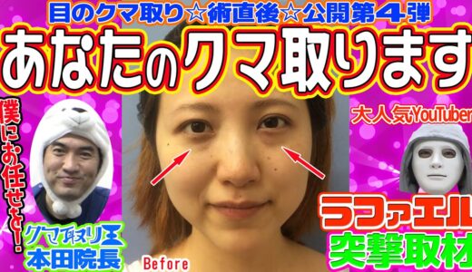 【目の下のクマ取り】術直後公開！美容整形初体験女性のクマ取ります