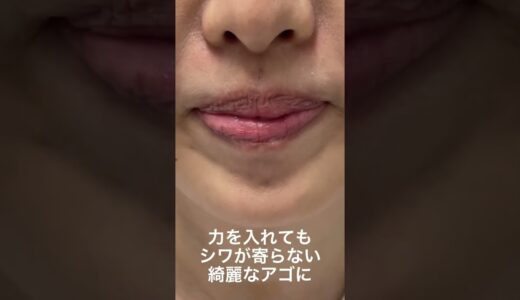 【美容整形】アゴのシワ消してみた#shorts