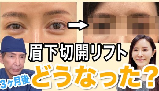 「くぼみが気になる…」眉下リフト・ハイフの３ヶ月後！【週末うめこコラボ】