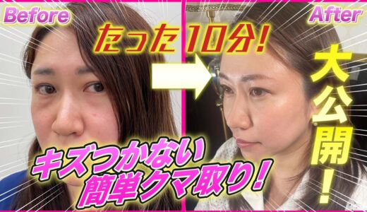 【目の下のクマ取り】超簡単10分美容整形！顔に傷つかない本気のクマ取りで老け顔にさようなら！