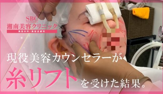 【現役カウンセラーの美容整形】今話題の糸リフトを美容カウンセラーが受けた結果…。★施術前～施術後～症例★#35