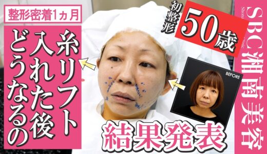 【アラフィフ糸リフト整形密着】ダウンタイム完全公開！若返り度・痛み・肌質の変化を正直レポートしました【タルミ・ほうれい線・フェイスラインを引き上げて小顔】＠湘南美容クリニック