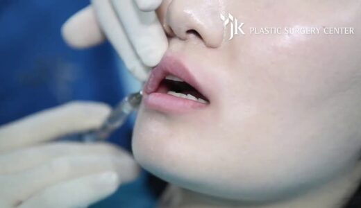 JK 美容外科 Japan Agency – (唇 – ヒアルロン酸) 韓国美容整形No.1 JK美容整形外科 – REAL B&A Lip Fillers at JK Plastic Surgery