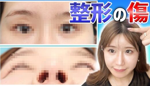 【美容整形】傷跡って残る？どこにできる？私の傷を見せながら解説します