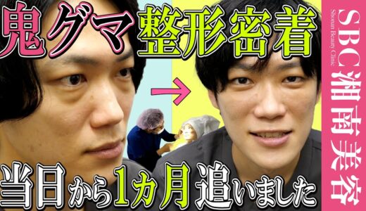 【目の下のクマを取る整形密着】リアルな腫れ感を施術を受けた34歳医師がレポート【お値段はラストに載ってます】湘南美容クリニック