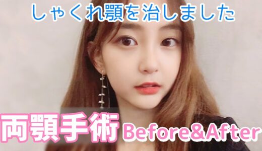 【美容整形】しゃくれ顎を治すために両顎手術を受けた女性のBefore&After