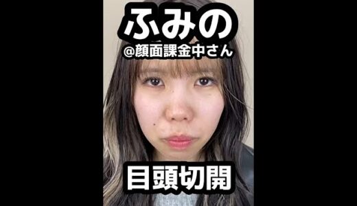 【整形】ふみのさん★目頭切開で外国人風二重に大変身?!#shorts