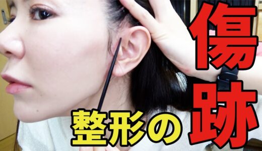 【病院名・美容整形の傷跡公開】超わかりやすい美容クリニックの選び方〜美容外科手術を考えている人へ〜