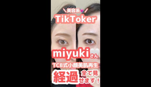 【TikToker】miyuki♡さん 糸リフトの全貌大公開！【美容整形】