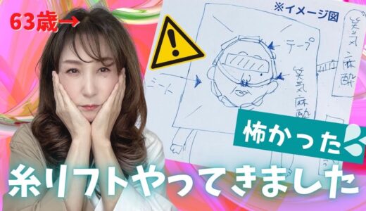 【糸リフト】糸リフトやってきました！腫れは？痛みは？効果は？ご報告の動画です⭐︎【美容医療】