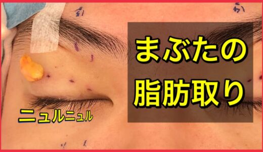 【美容整形】【閲覧注意】まぶたの脂肪取り