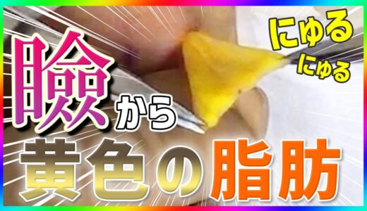 【閲覧注意】まぶたの脂肪取りで目元を好印象に！Eyelid fat removal 【整形】