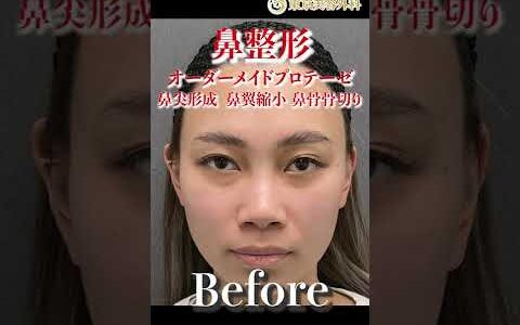 【鼻整形】鼻が低いと言われたので整形してみた!! 　before/after #整形 #鼻整形 #お金持ちの息子の親父 #麻生泰 #東京美容外科 #豊胸 #Shorts