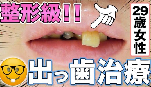 【29歳女性】整形級出っ歯治療🦷  [29 year old female] Plastic surgery-grade bucktooth treatment 🦷