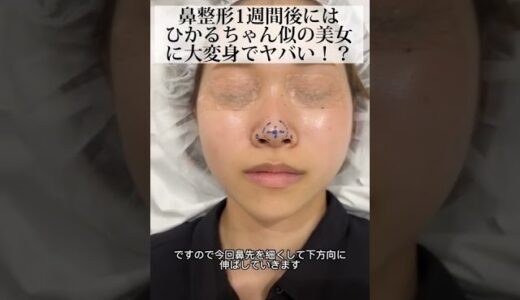 【鼻整形/鼻尖形成】鼻整形一週間後にはひかるちゃん似の美女に大変身でヤバイ！？ #shorts