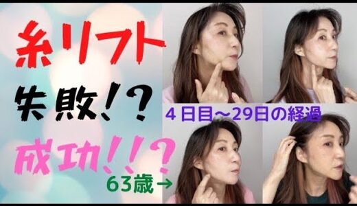 【糸リフト】糸リフト手術後経過4日〜29日の動画です。コレは成功なのか！？【美容医療】【たるみ】