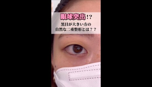 【二重整形】眼球突出ってなに？！　#shorts