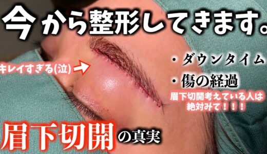 【美容整形】縫合がめちゃくちゃ上手いドクターに眉下切開してもらった結果が凄すぎる【眉下リフト】