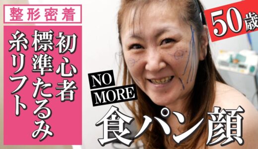 【糸リフト整形密着】50代ママのはじめて糸リフト10本➡シワ・たるみを上げた結果【ヒアルロン酸併用】湘南美容クリニック