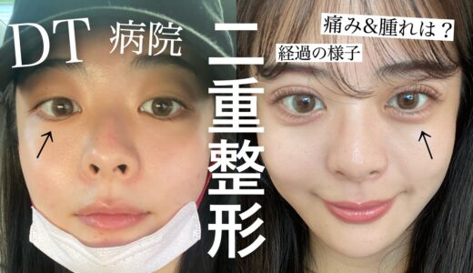 【二重整形】念願の埋没しました。ダウンタイム全て公開します👁♡