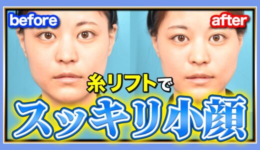 【美容整形】糸リフトを受けたモニター様に完全密着！