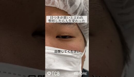 【二重整形】男性の二重整形！#shorts