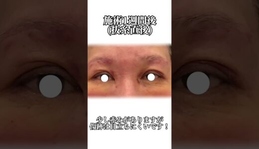 【美容整形】眉下リフト術経過お見せします#shorts