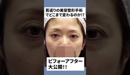 若返り美容整形でこんなに変われます