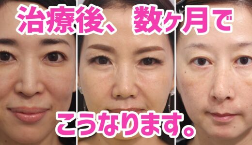 整形しないアンチエイジング美容医療「肌の再生医療」ビフォーアフター｜時間が経てば経つほど良くなっていきます