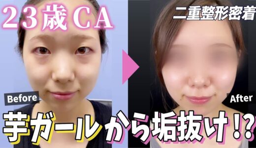 【埋没×目頭切開×クマ取り】目元大変身！？美人CAさんの美容整形に密着！！【二重整形】【二重埋没】