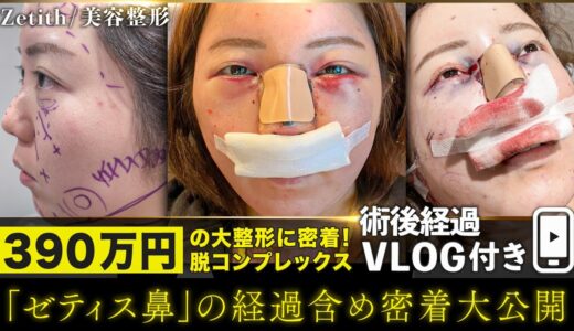 【整形】全顔美容整形の一部始終を密着大公開 / ダウンタイム中の経過映像も特別公開【くま取り・脂肪吸引・糸リフト・鼻整形・脂肪注入】#ゼティス鼻 #美容整形  #zetithbeautyclinic