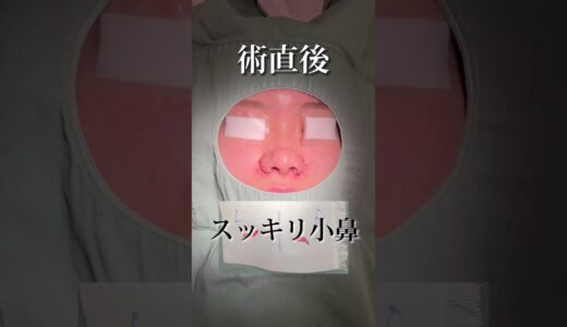 【鼻整形】小鼻縮小の全て見せます！#shorts