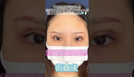 全切開のダウンタイム大公開！【新宿】【美容外科】【美容整形】【切開法二重】【眼瞼下垂手術】