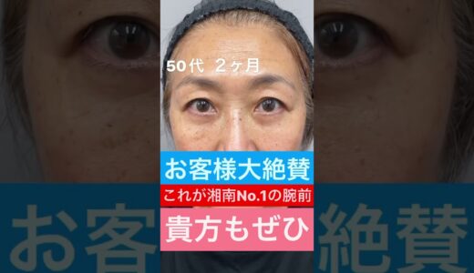 50代に奇跡を起こすクマ取り 目の下のクマ取りたるみ取り美容整形 予約は☎️0120489100 #美容整形#目の下のたるみ#目の下のくま#くまとり#クマ取り#目の下のクマ#shorts