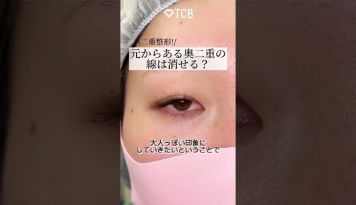 【二重整形】元からある奥二重の線は消せる？#shorts