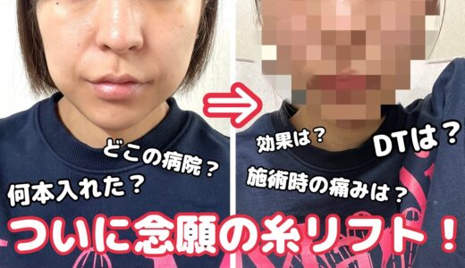 [韓国美容整形]ついに念願の糸リフト！💆‍♀️施術やダウンタイム、値段についての正直レポ🌸