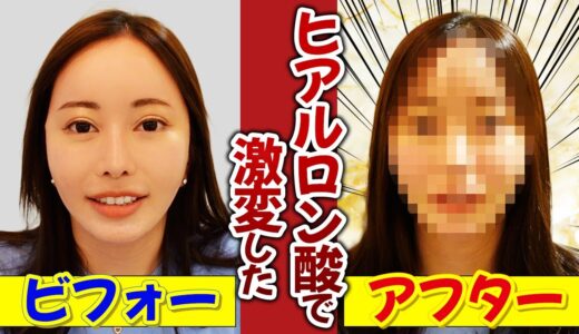 ヒアルロン酸とボトックスだけでコンプレックスを克服。感動して涙が出る。